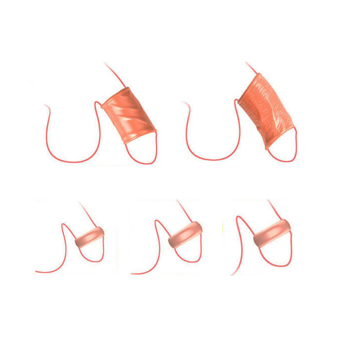 Kit com 5 Anéis Penianos Realísticos em Silicone Atóxico com Veias Salientes - Cock Ring | 5,2 x 1,9 cm - 2