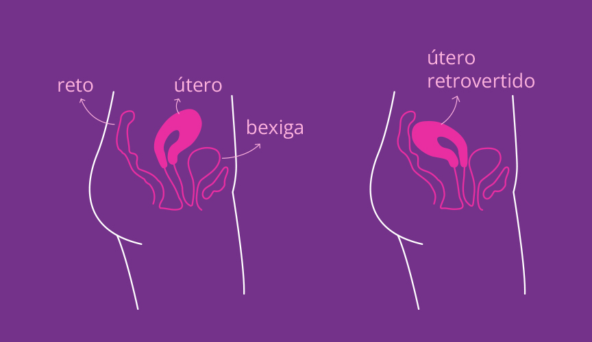 Como o útero retrovertido pode afetar a sua saúde e o prazer?