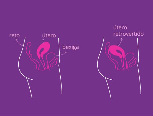 Como o útero retrovertido pode afetar a sua saúde e o prazer?