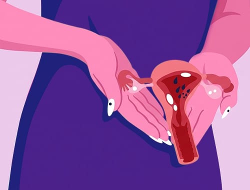 Endometriose e fertilidade: o que você precisa saber